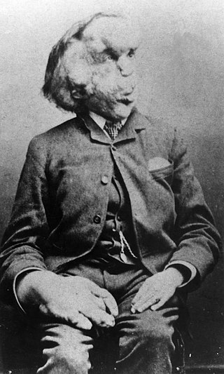 image of Joseph Merrick